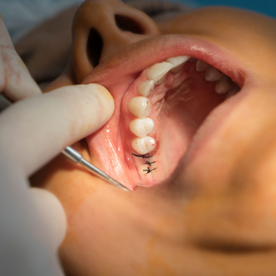Chirurgie dentoalveolară